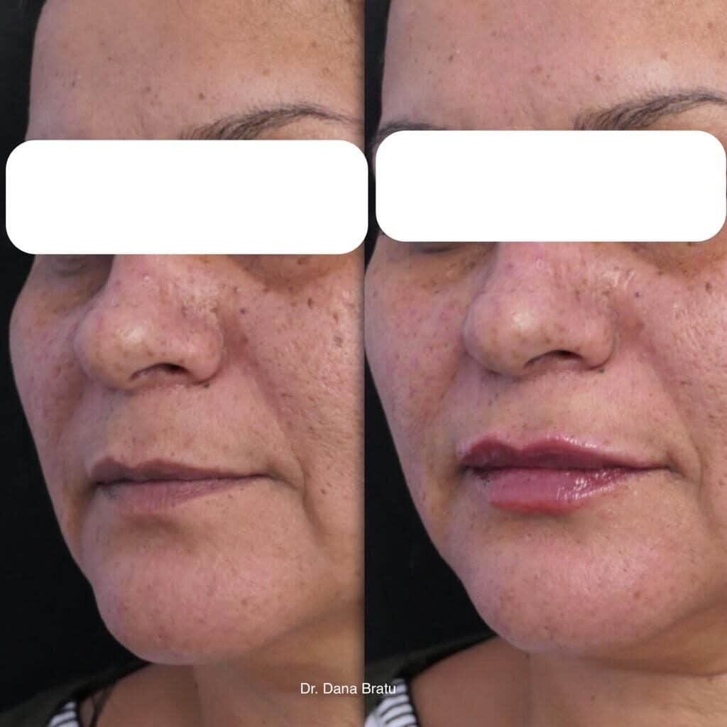 marirea-buzelor-dermabeauty-clinique Marire buze