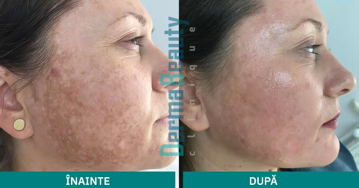 Imagini before-after Tratament Cosmelan (profil dreapta)