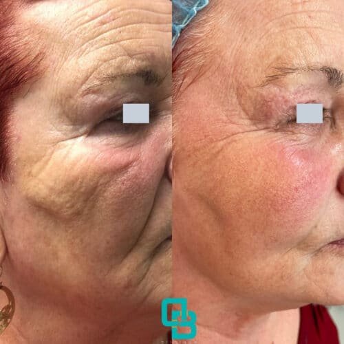 Rejuvenarea faciala cu laserul eCO2 fractionat