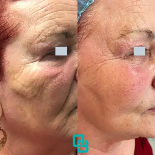 Rejuvenarea faciala cu laserul eCO2 fractionat