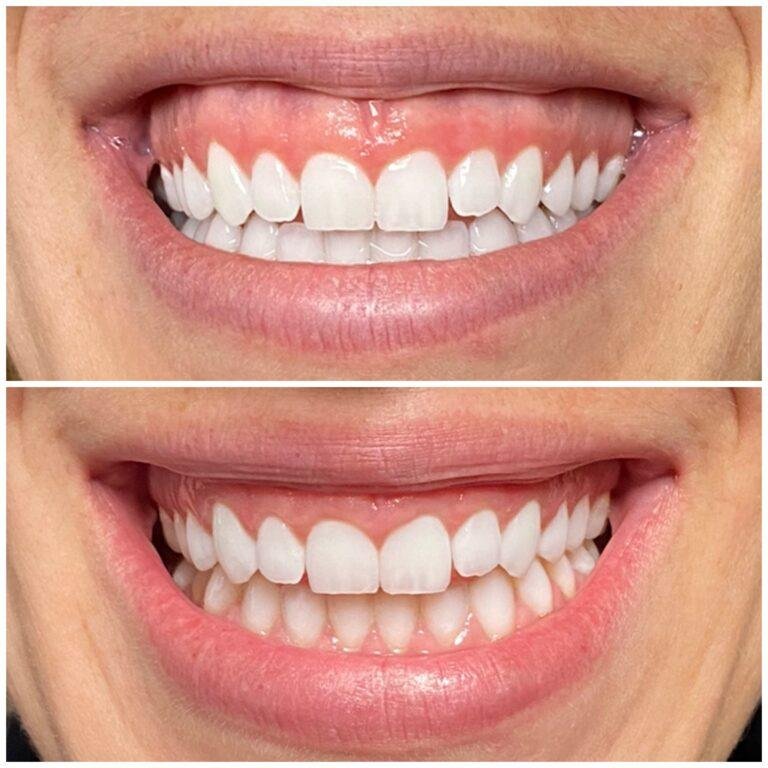 gummy-smile Gummy Smile