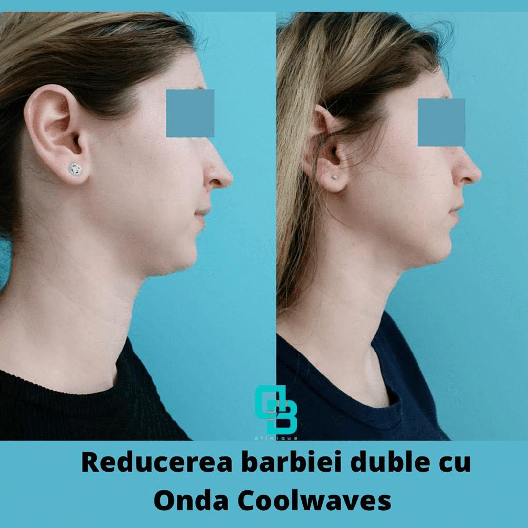 Reducere barbie dubla cu Onda CoolWaves