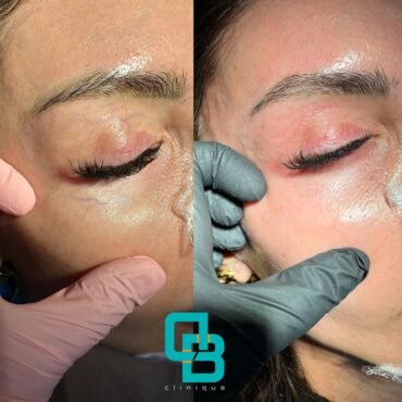 Laser vascular telangiectazii la nivelul cearcanelor