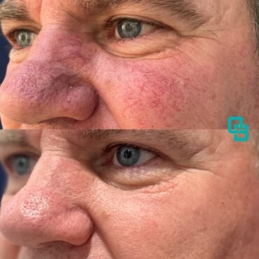 Tratament cuperoza (before-after)