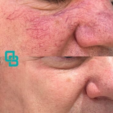 Tratament cuperoza (before-after)