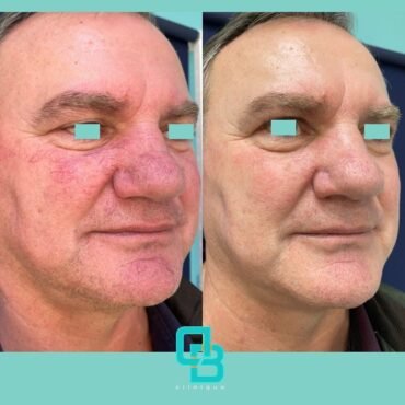 Tratament rozacee laser vascular