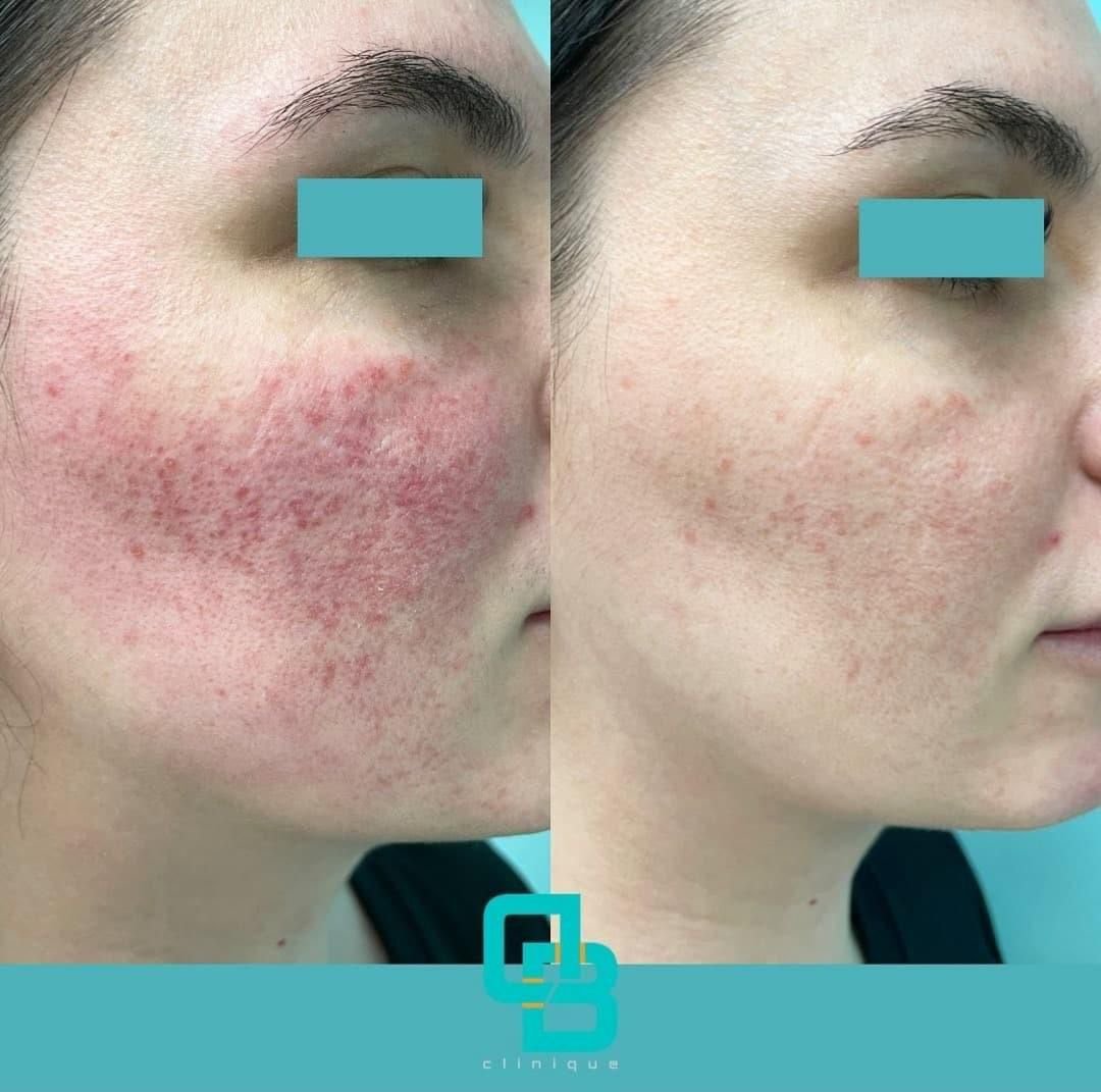 Tratament rozacee (before-after)