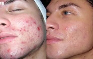 Rezultate tratament dermalinfusion (before si after)
