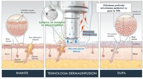 Tratament Dermalinfusion