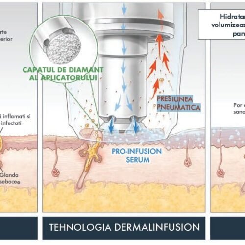 Tratament Dermalinfusion