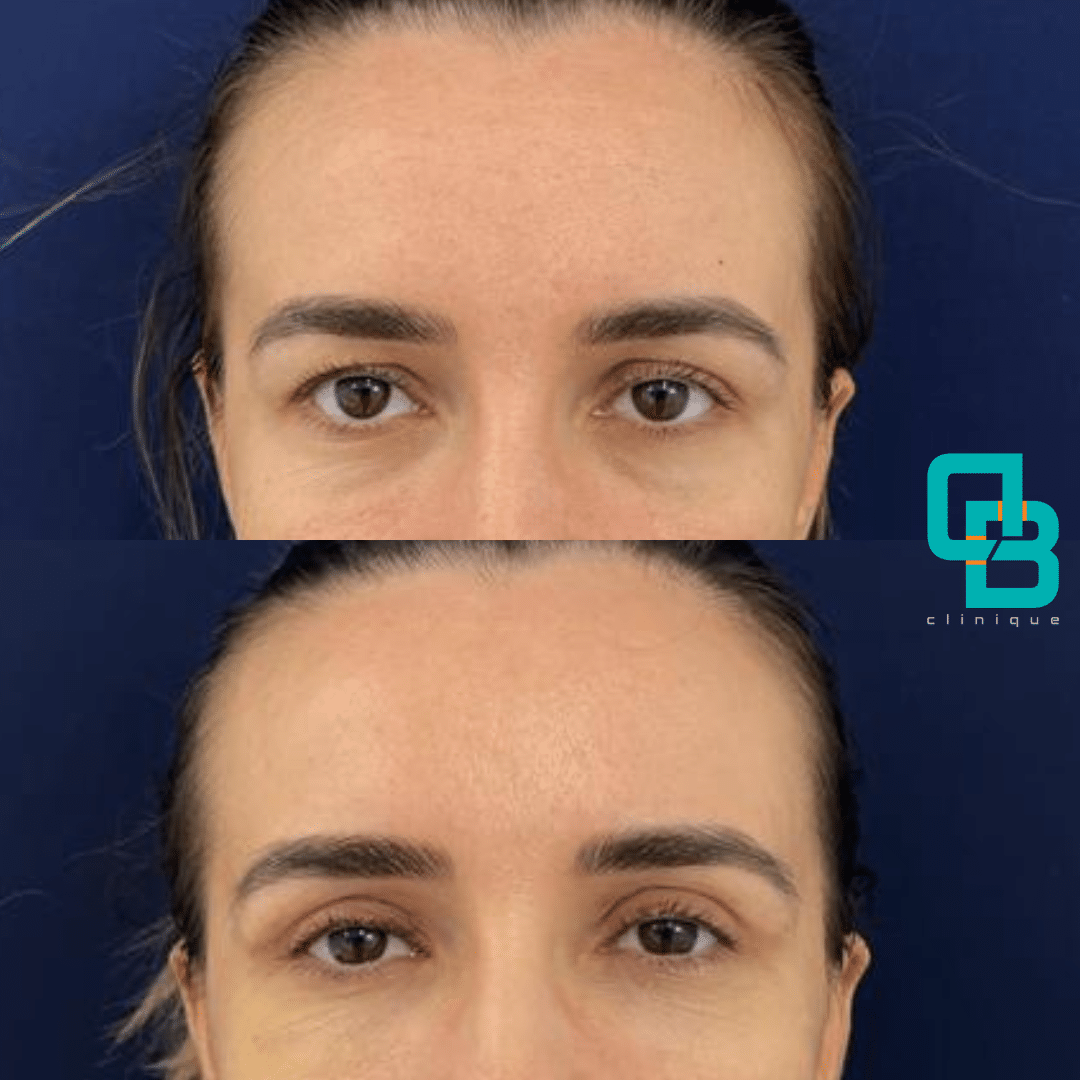 Blefaroplastie Chirurgicala Blefaroplastie Chirurgicala