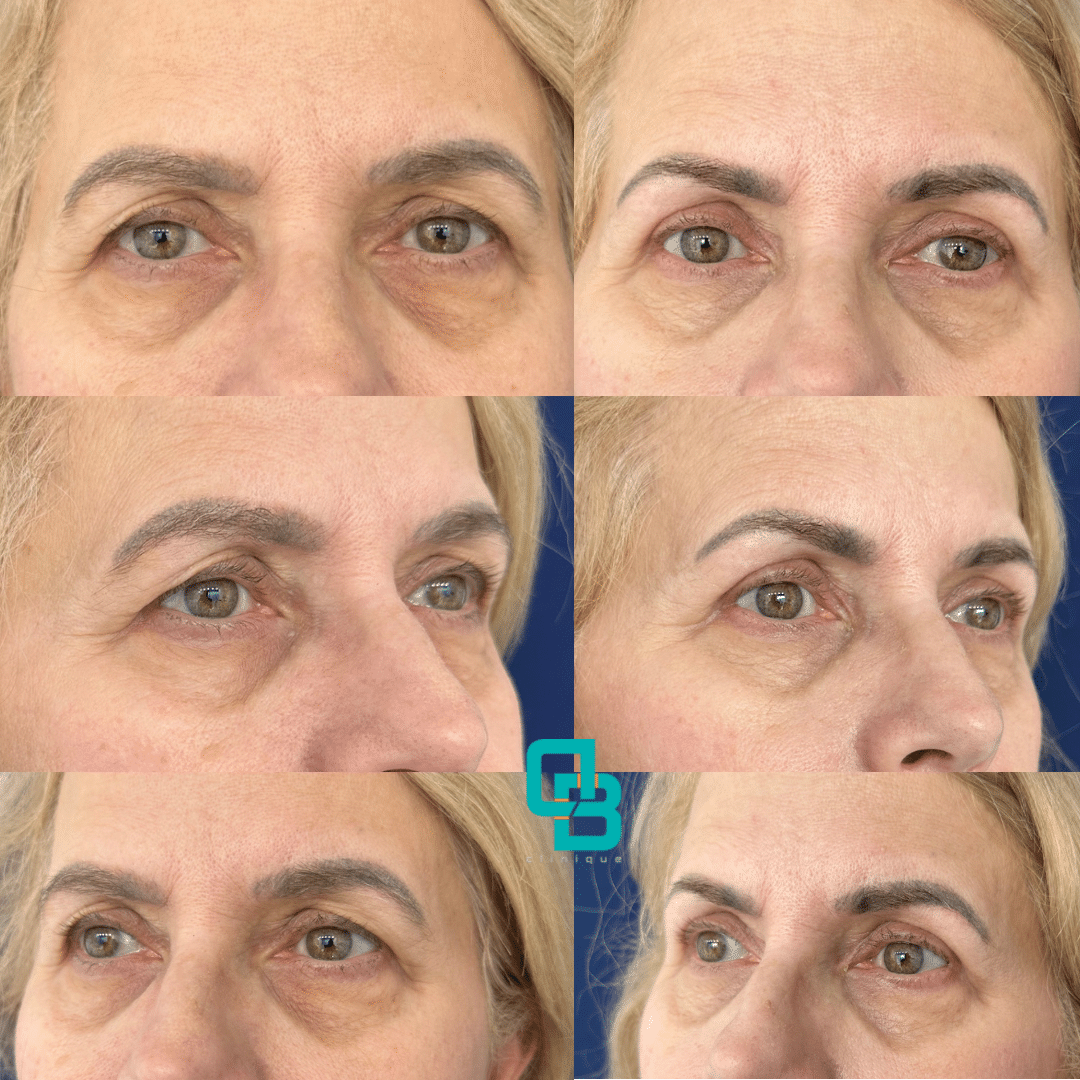 blefaroplastie-chirurgicala-superioara Blefaroplastie chiurgicala superioara in cadrul Clinicii DermaBeauty