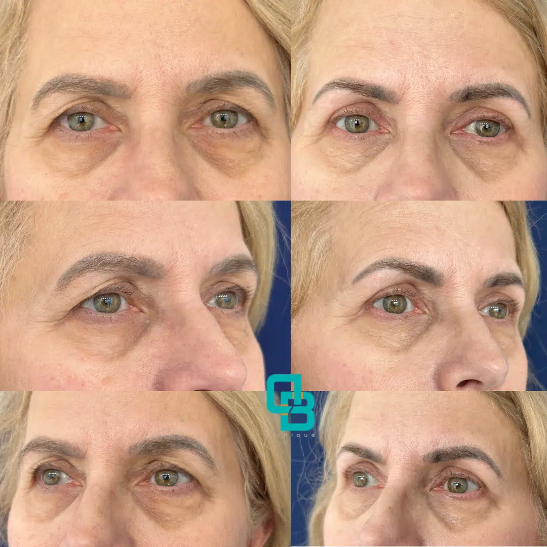 Blefaroplastie chiurgicala superioara in cadrul Clinicii DermaBeauty