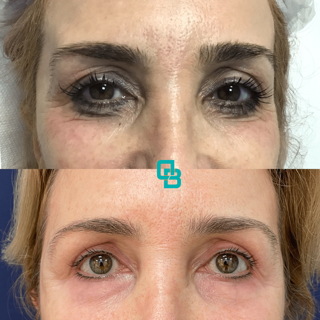 corectie-cearcane Corectia cearcanelor cu acid hialuronic in cadrul Clinicii DermaBeauty