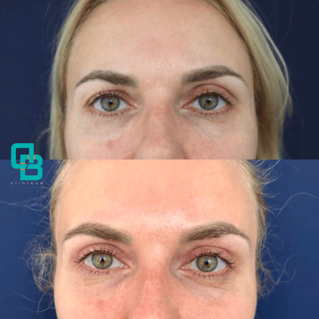 Blefaroplastie Chirurgicala Blefaroplastie Chirurgicala