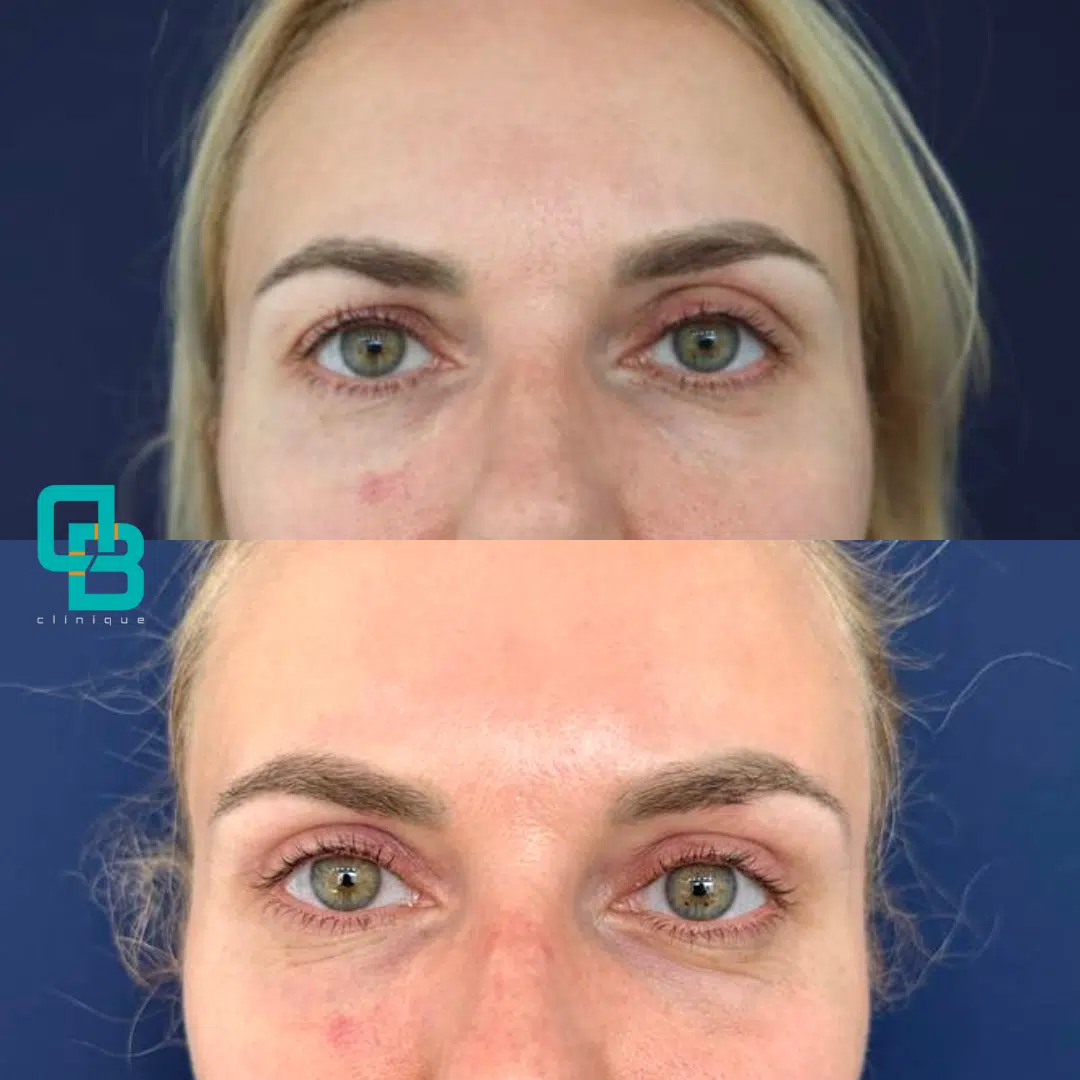 Blefaroplastie Chirurgicala