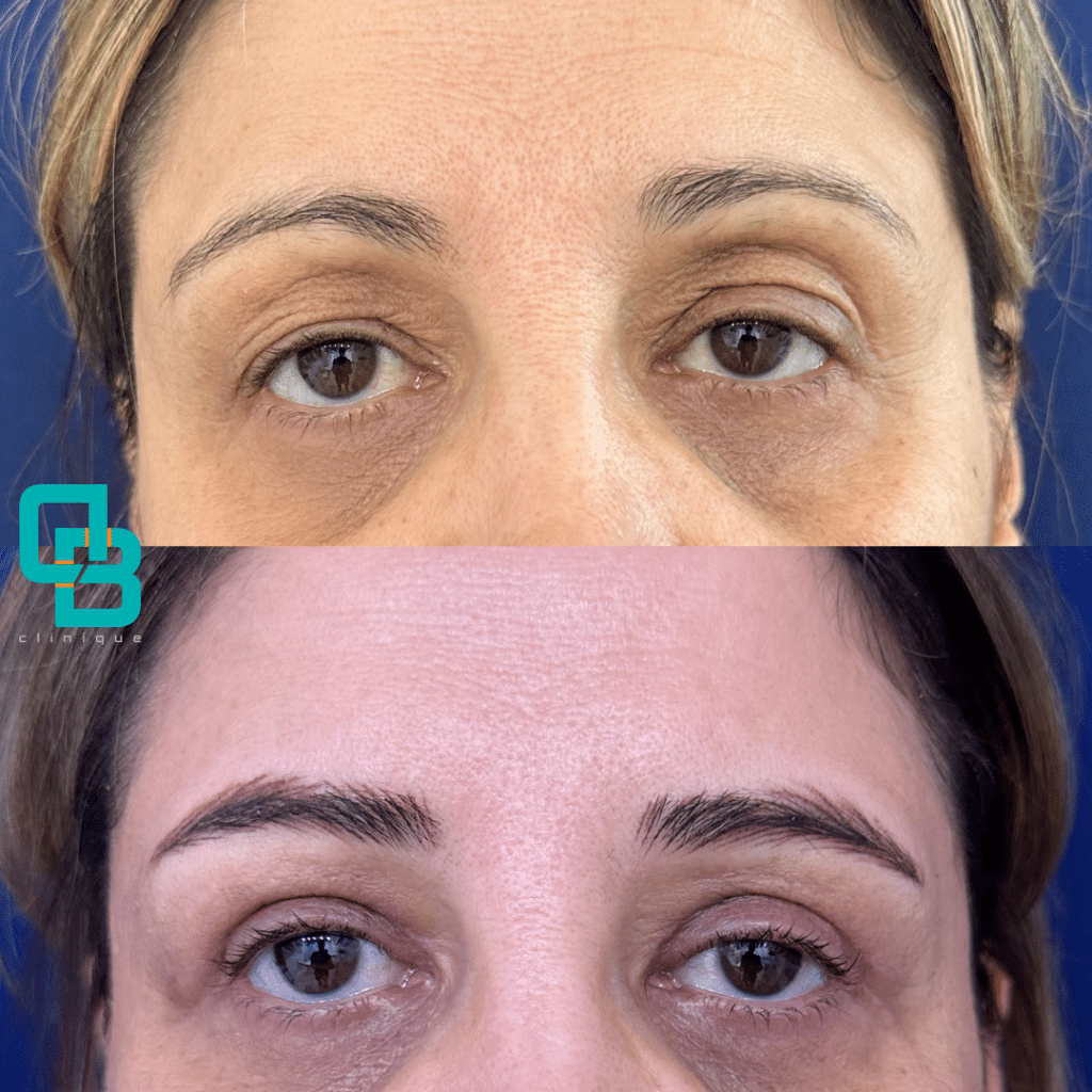 Blefaroplastie Chirurgicala Superioara Operatie Pleoape Cazute Dermabeauty Clinique