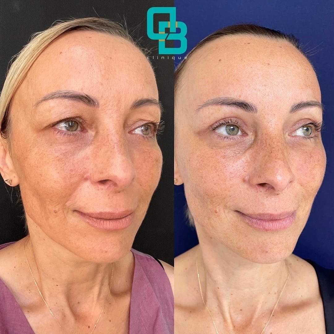 blefaroplastie-chirurgicala Interventie chirurgicala (blefaroplastie superioara)