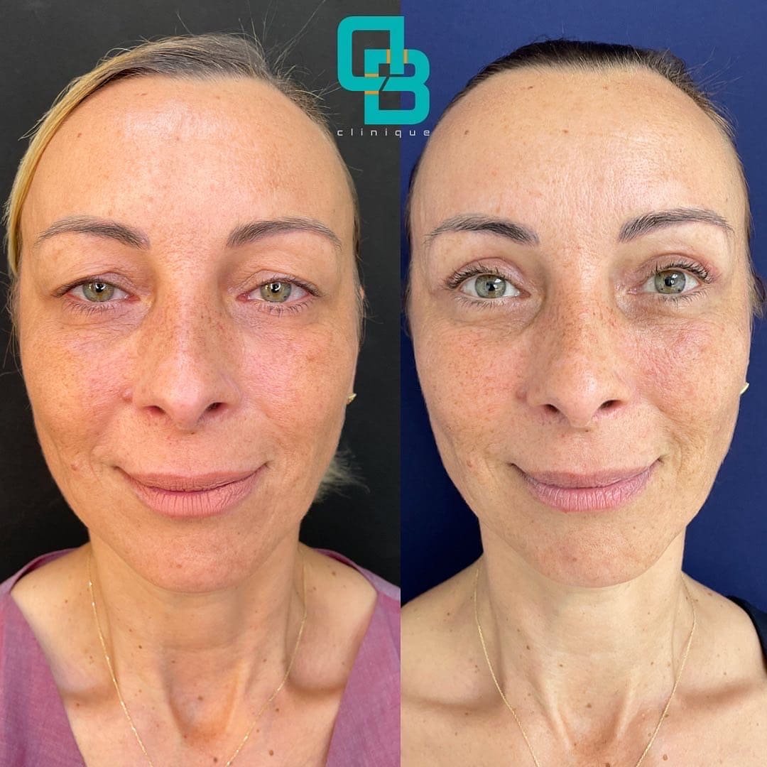 blefaroplastie-superioara-chirurgicala Blefaroplastie superioara chirurgicala (DermaBeauty Clinique)