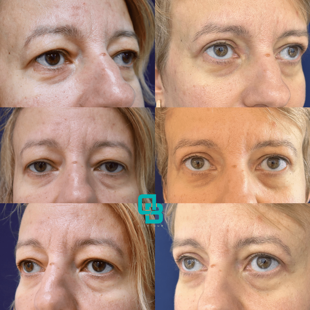 procedura-blefaroplastie-chirurgicala Procedura de blefaroplastie superioara chirurgicala (DermaBeauty Clinique)