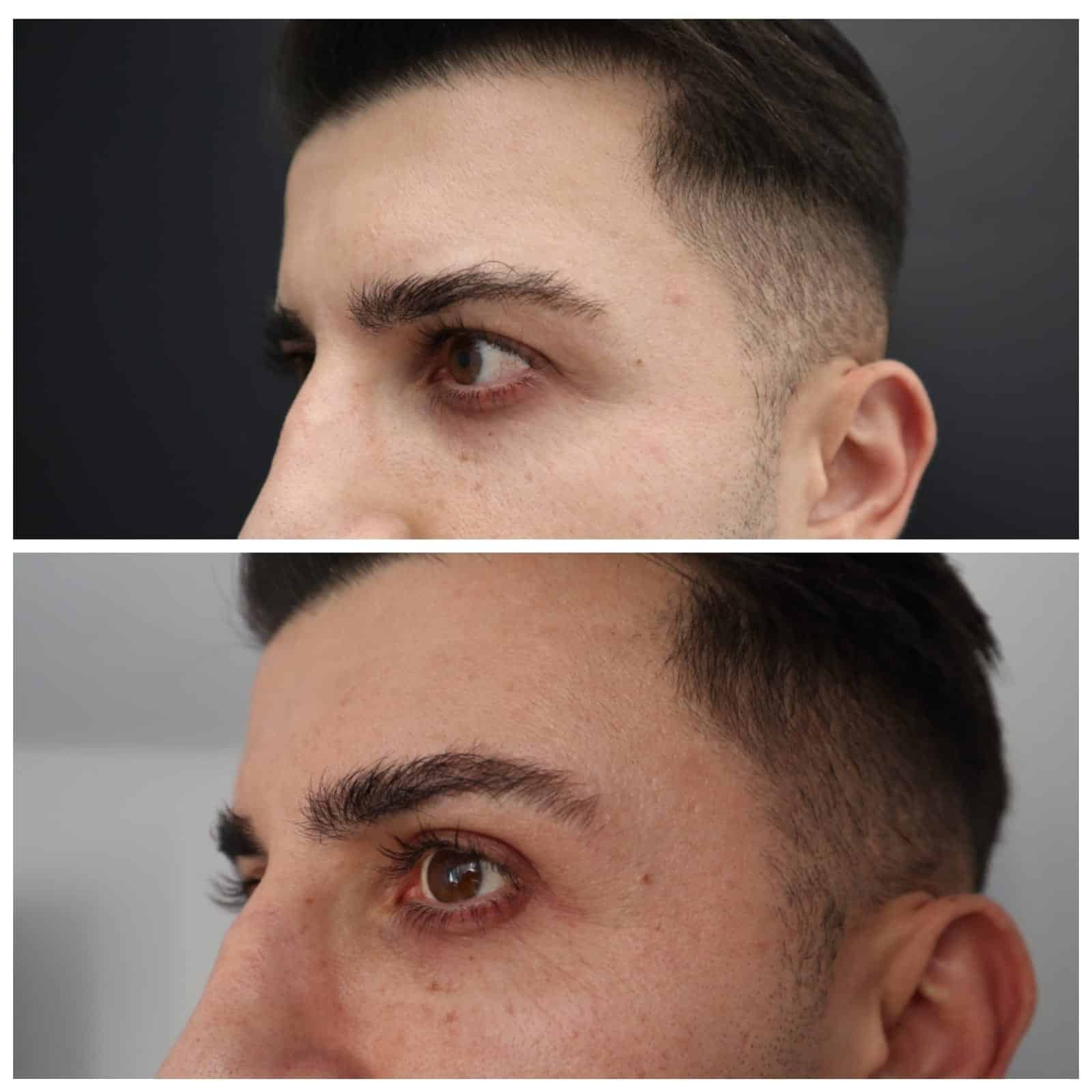 Before-after blefaroplastie superioara