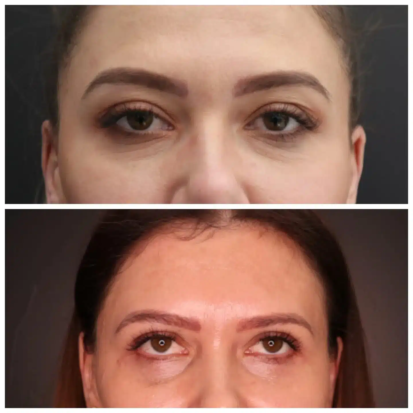 Before-after blefaroplastie superioara