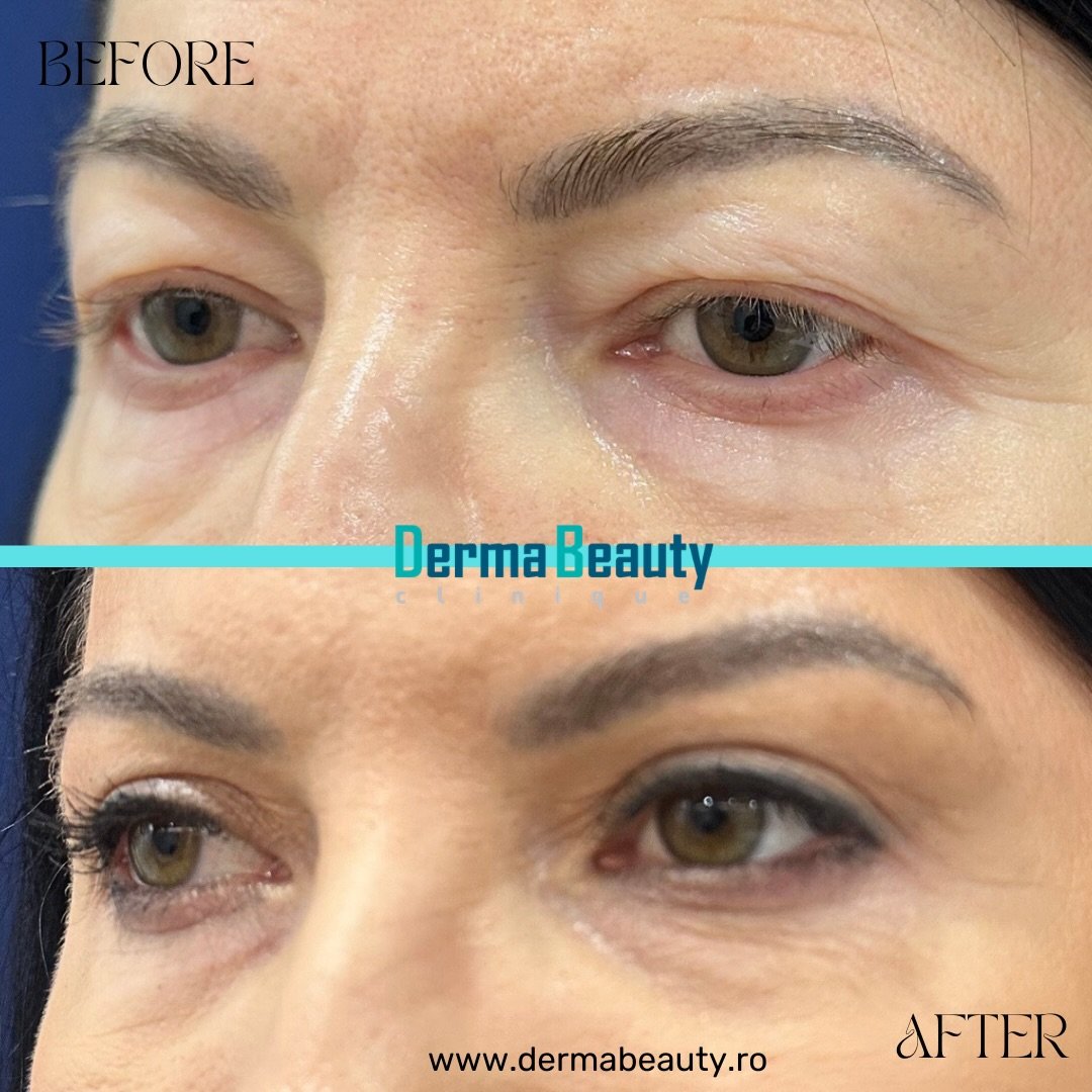 blefaroplastie-superioara-chirurgicala-1-2026 Blefaroplastie Superioara Chirurgicala