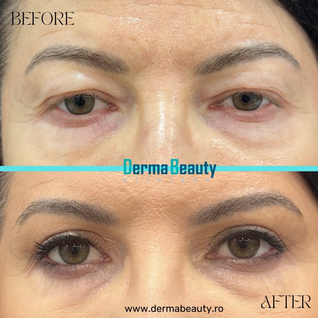 blefaroplastie-superioara-chirurgicala-2-2026 Blefaroplastie Superioara Chirurgicala (caz nou! 2026)