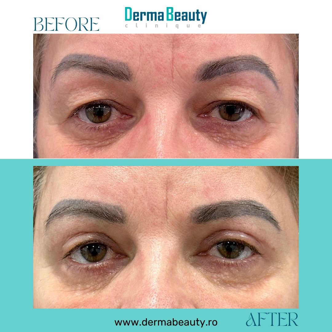 blefaroplastie-superioara-chirurgicala-3-2026 Blefaroplastie Superioara Chirurgicala 2026