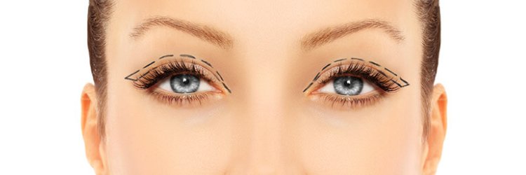 blefaroplastie-superioara-chirurgicala-abstract2 Blefaroplastie Superioara Chirurgicala Abstract