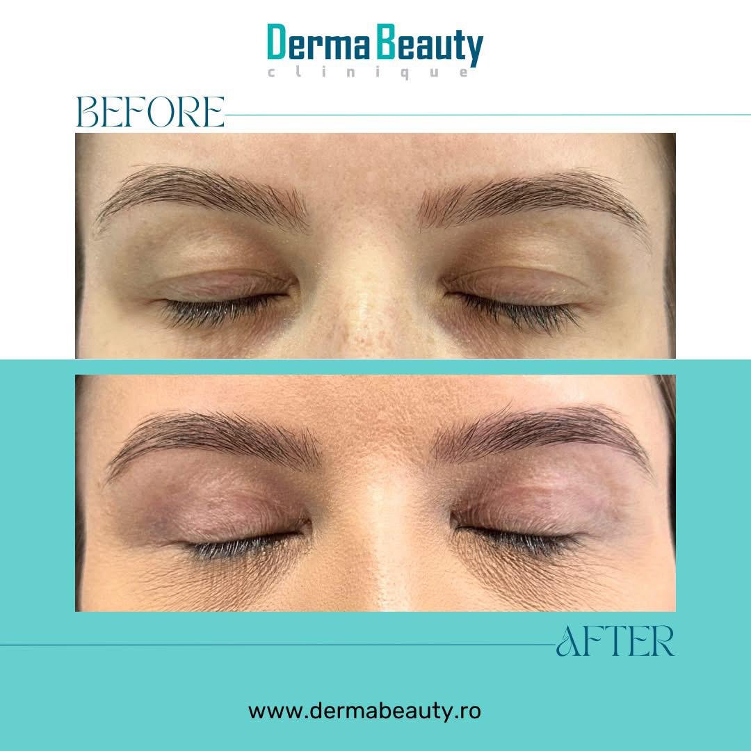 blefaroplastie-superioara-dermabeauty-clinique4 Blefaroplastie superioara chirurgicala