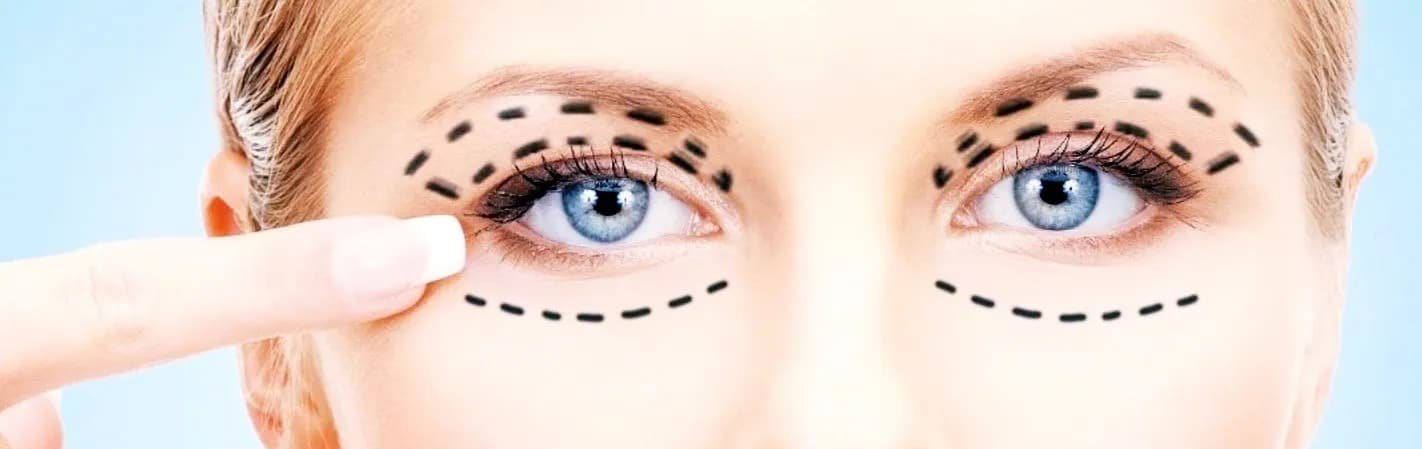 blefaroplastie-superioara-dermabeauty2