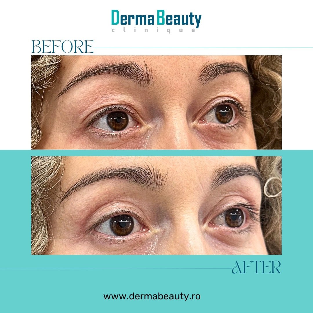 Copie a Copy of Derma Beauty Instagram - 47 Indepartare piele pleoape superioare