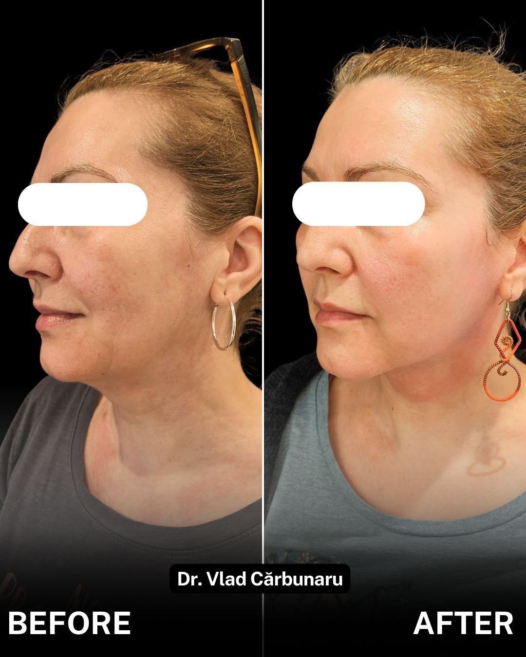 Eliminare gusa cu procedura de FaceTite