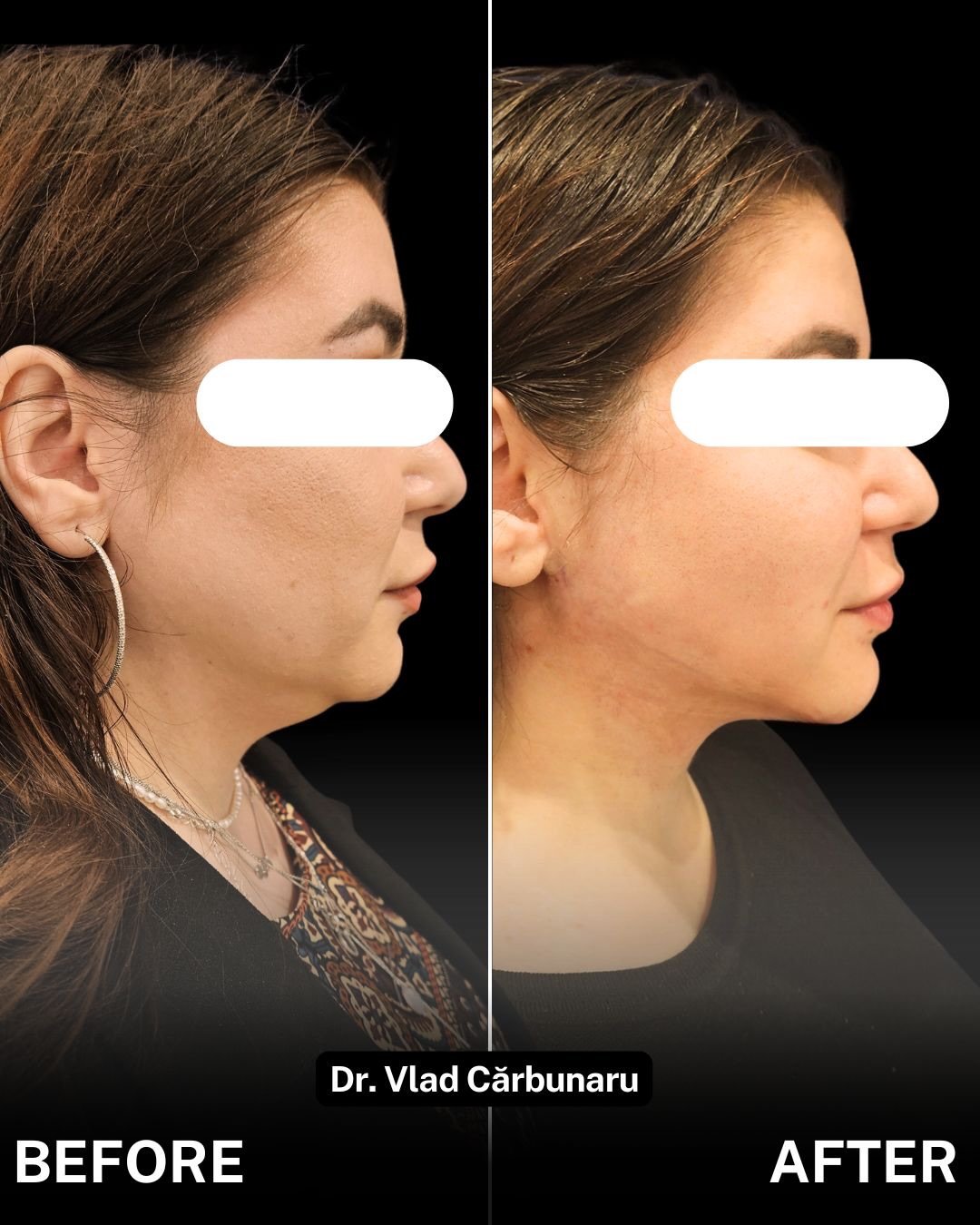 Liposcutie Faciala: eliminare gusa