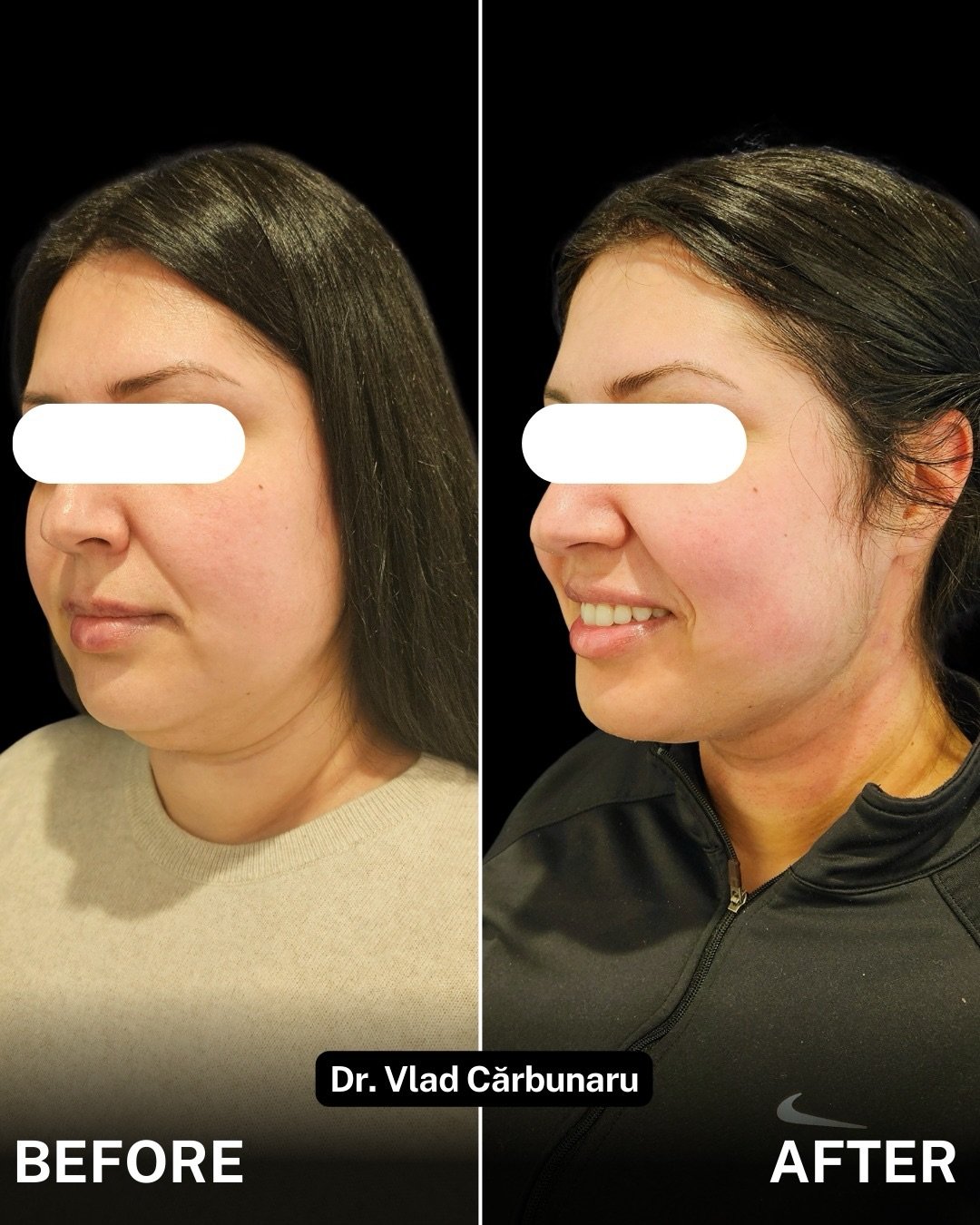 Eliminare barbie dubla