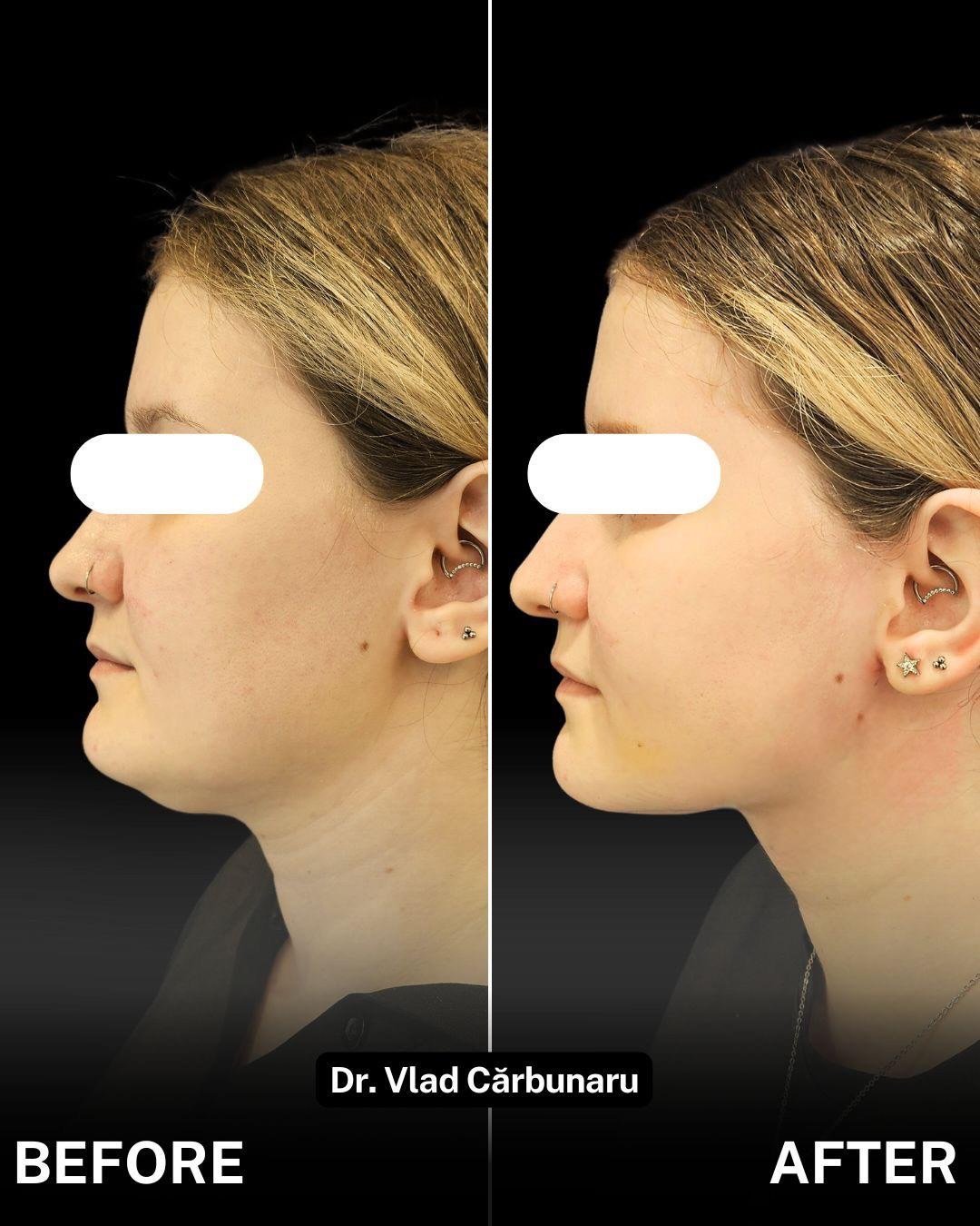 Liposcutie Faciala: eliminare gusa