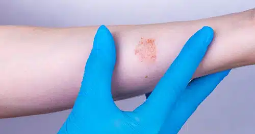 Dermatita atopica