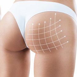 BBL (Brazilian Butt Lift)