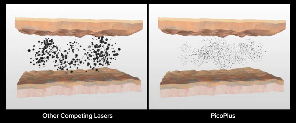 Laser PicoPlus