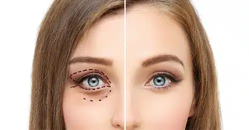 Blefaroplastie superioara chirurgicala