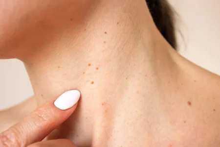 Indepartarea papiloamelor de la nivelul gatului