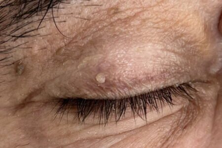 Indepartarea papiloamelor de la nivelul ochilor