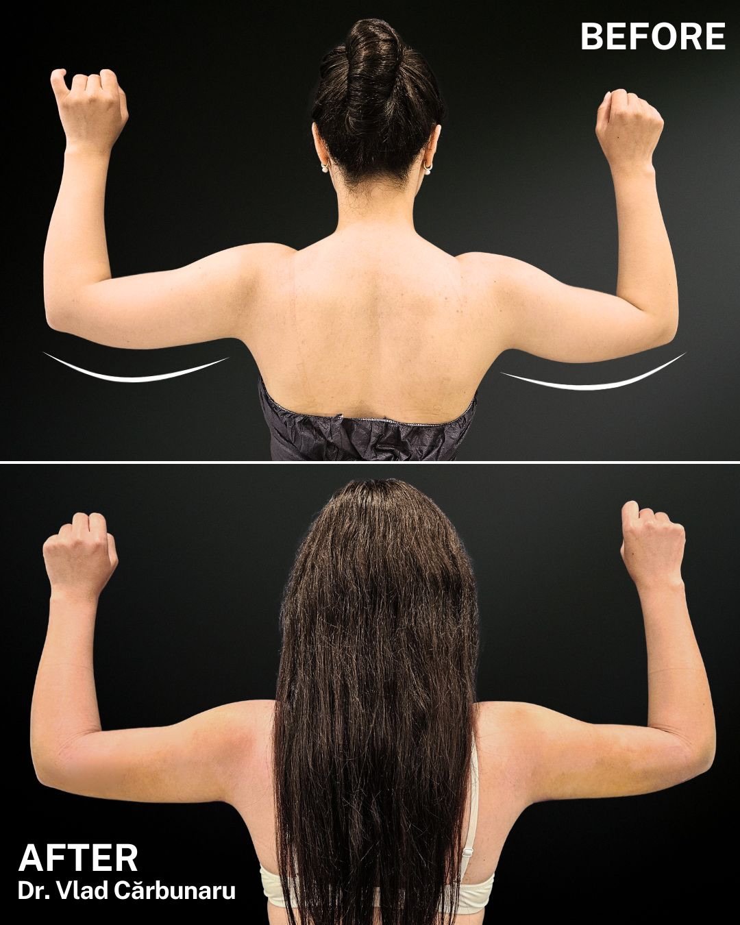 body-tite-liposuctie-brate Liposuctie corporala la nivelul bratelor