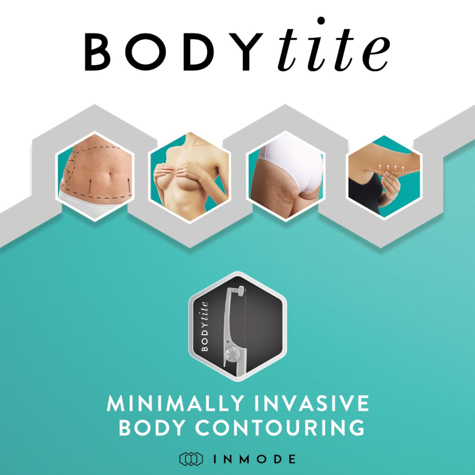 Liposuctie minim invaziva: BodyTite