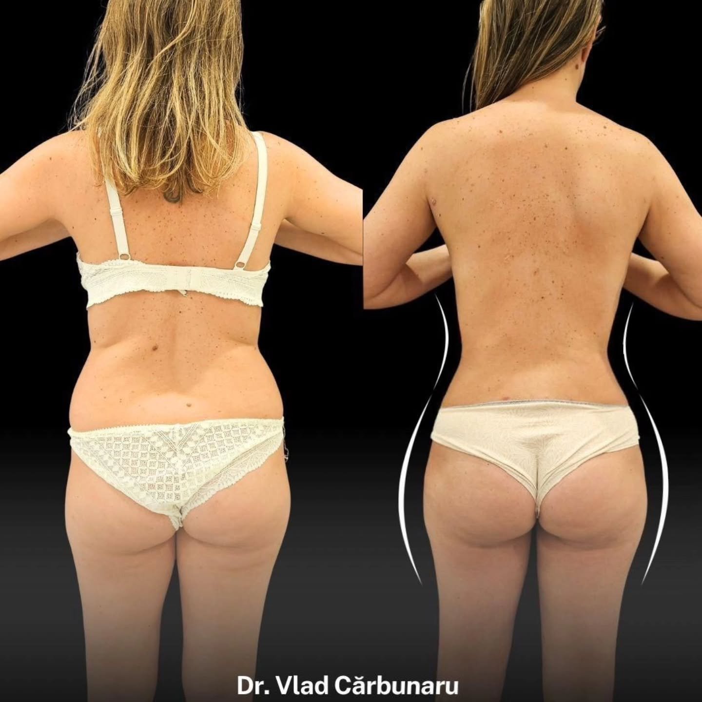 liposuctie-corporala-body-tite-dermabeauty-clinique Liposuctie corporala