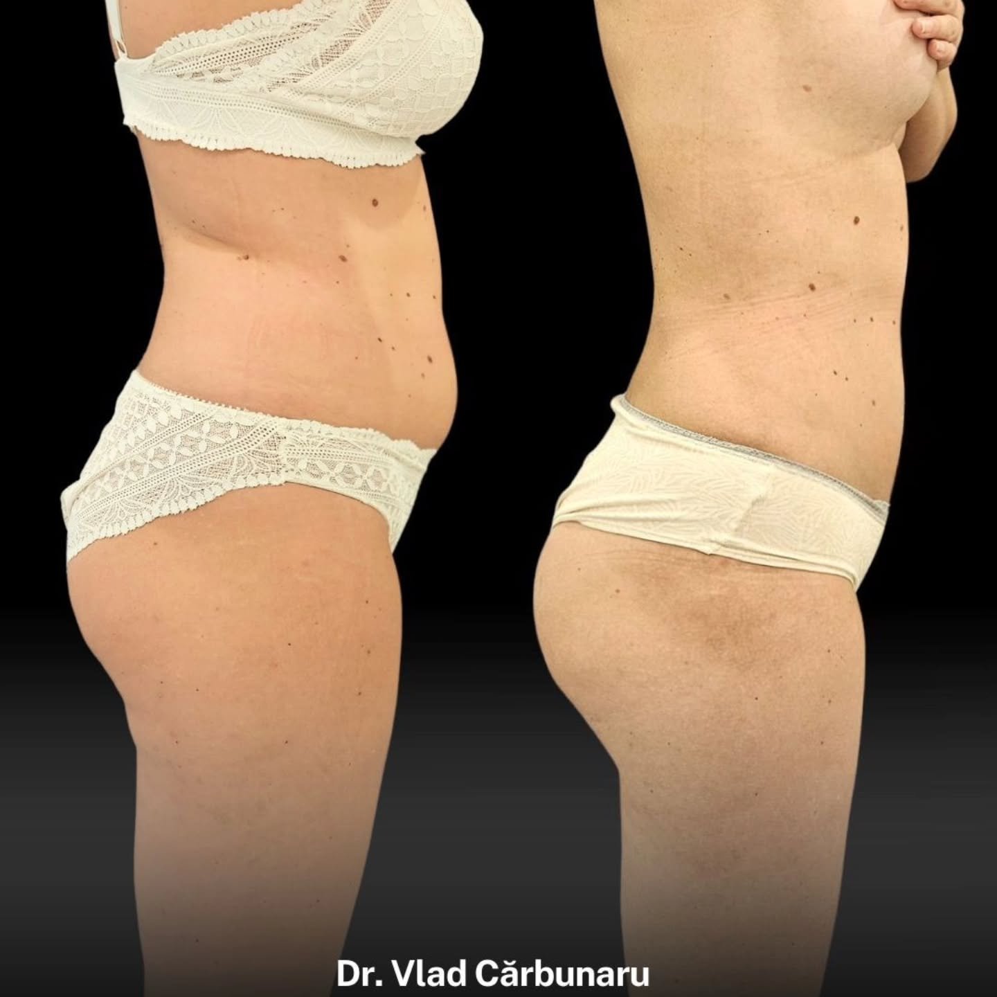 liposuctie-corporala-lateral-body-tite-dermabeauty-clinique Liposuctie corporala (vedere laterala)