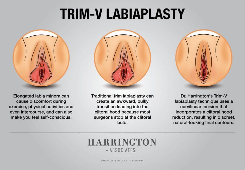 Labioplastie Trim V