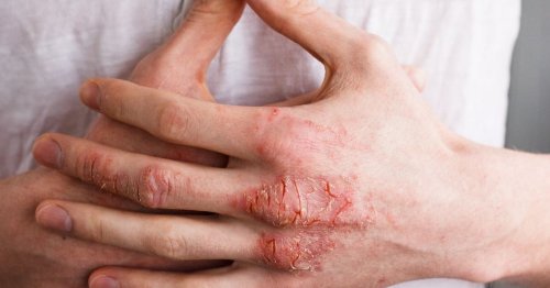 Eczema: cauze si tratament