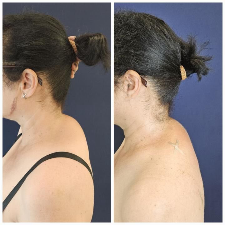 Lipoaspiratie "Cocoasa de bizon"